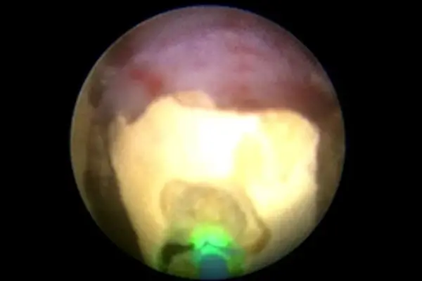 LASER surgery for Large Kidney stones | Dr. Praveen Pandey Lucknow