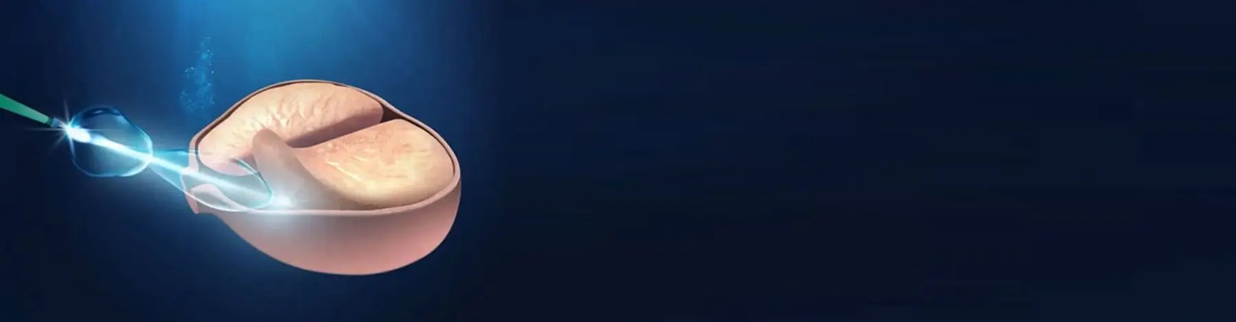 Laser Surgery For Prostate Enlargement