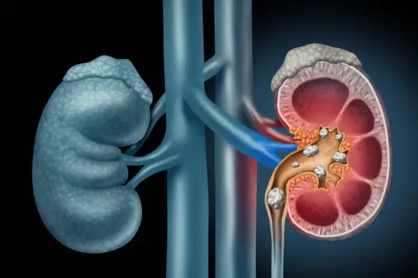Scarless Surgery for Kidney Stones